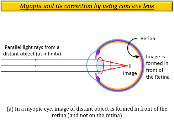 írja le látássérült myopia