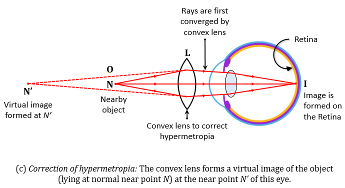 Name the defect of vision in a person a whose near - Tutorix